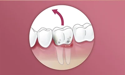 Extração Dente Comum