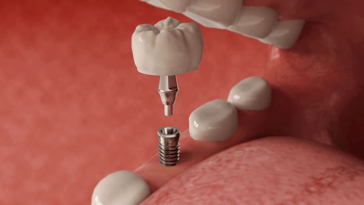 Implantes Dentários: Tudo Que Você Precisa Saber